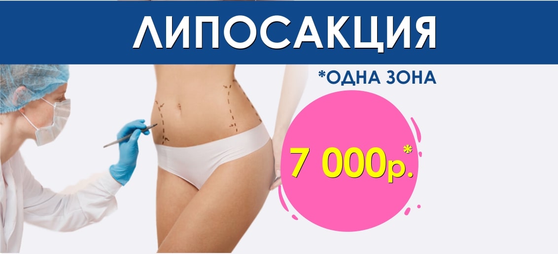 ВЫГОДНОЕ предложение: липосакция одной зоны всего 7 000 рублей до конца июля!
