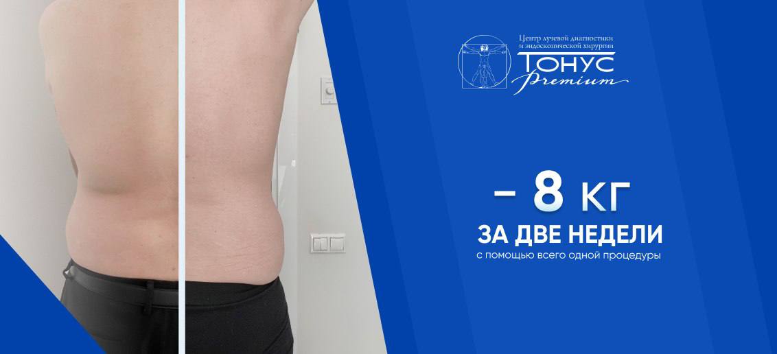 Минус 8 кг за 2 недели с помощью криомоделирования Coccon Cooltech
